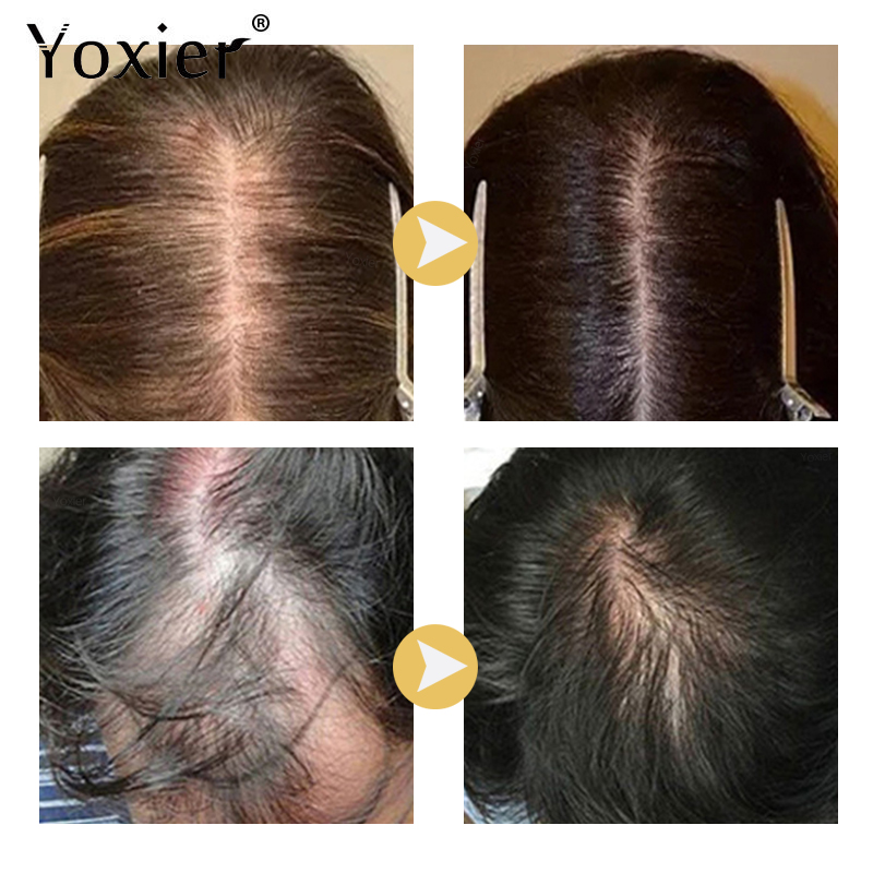 Intensive Growth Serum Prevent - Hair Care For Hair Loss 评论和价格
