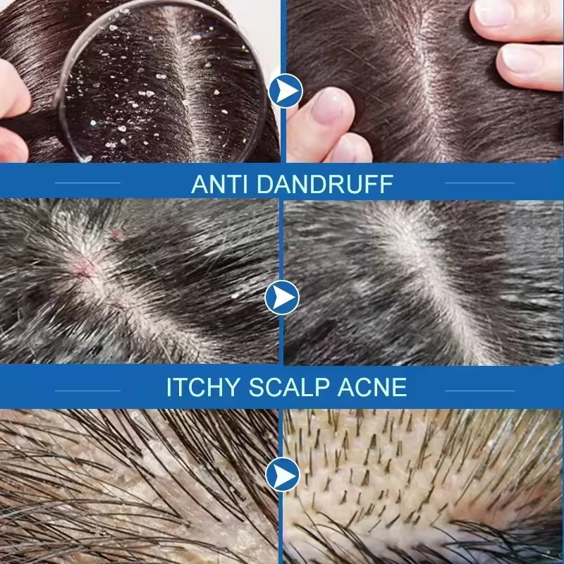 Fast Anti Dandruff Hair Treatm - Hair Care Dandruff 评论和价格