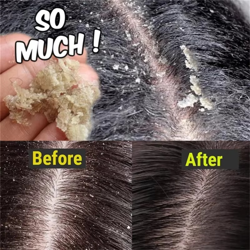 Fast Anti Dandruff Hair Treatm - Hair Care Dandruff 评论和价格
